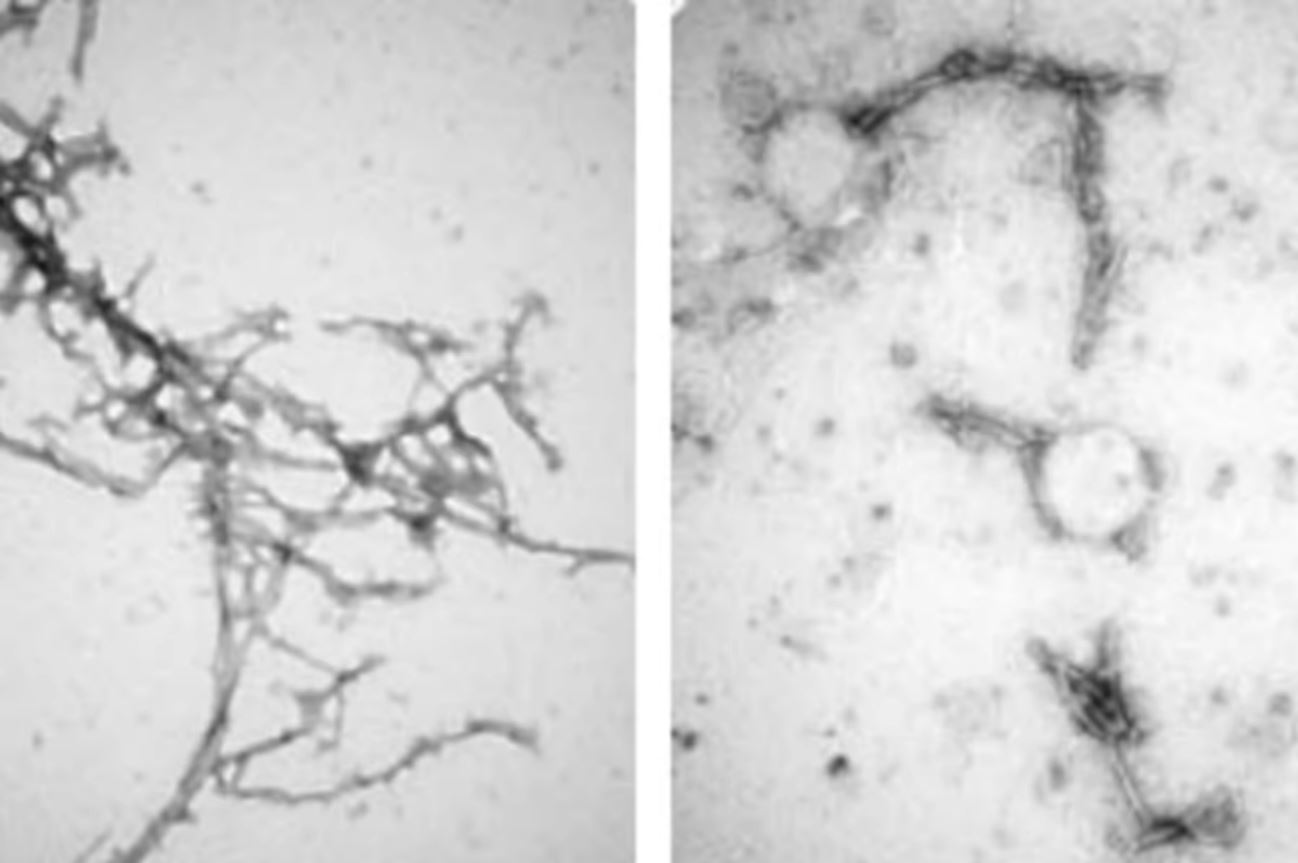 Điều trị bằng công nghệ nano loại bỏ các khối protein trong não của bệnh Parkinson