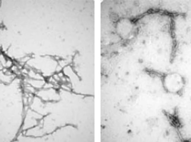 Phương pháp điều trị bằng công nghệ nano có thể giúp loại bỏ các khối protein trong não của bệnh Parkinson